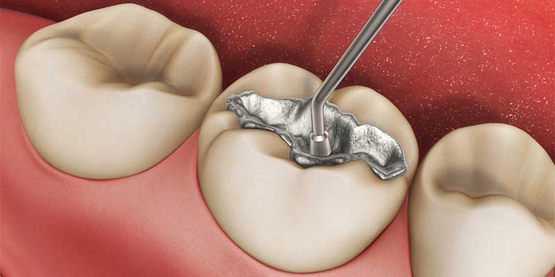Diş Dolgusu